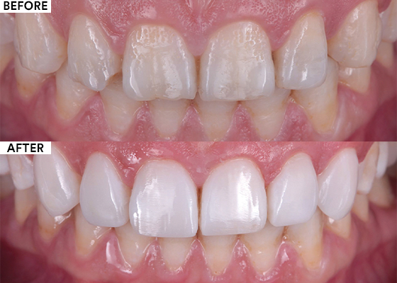 Clinical Case: Direct Composite Veneers - 3M Dental Blog