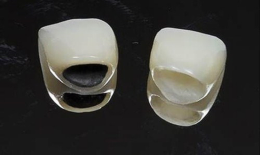 So sánh giữa răng kim loại và răng toàn sứ? Nha khoa Thùy Anh - nhakhoathuyanh